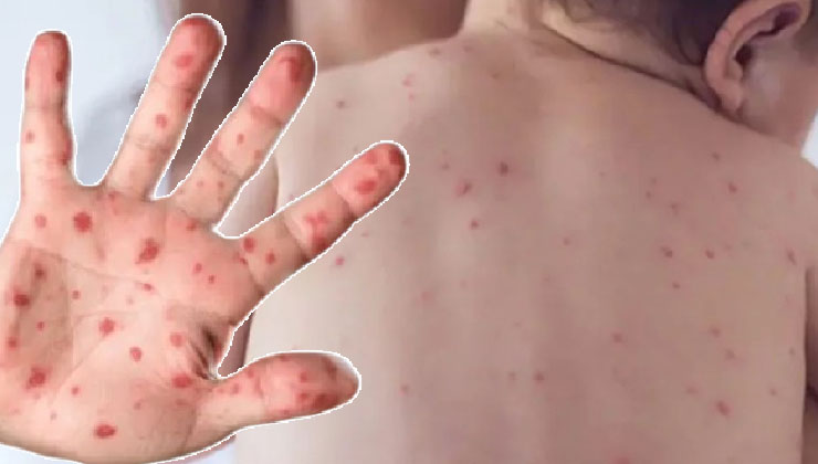 হামে আরও ৫ শিশুর মৃত্যু, দেশে বাড়ছে সংক্রমণ