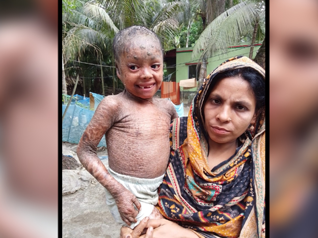 বিরল চর্মরোগে আক্রান্ত ছোট্ট তানিয়া বাঁচাতে দরকার সবার সহানুভূতি